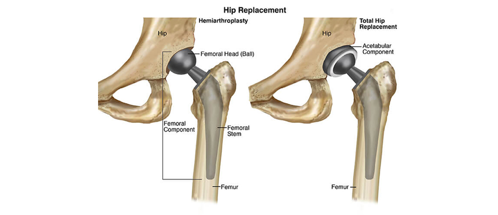 Hip replacement